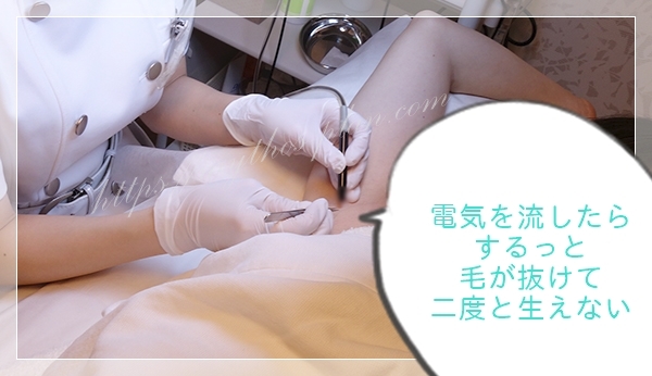 Tbc終わりのある脱毛・細い金属・プローブを毛穴に入れている様子