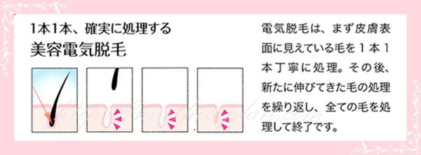Tbcの美容電気脱毛は一本一本確実に処理できる脱毛方法