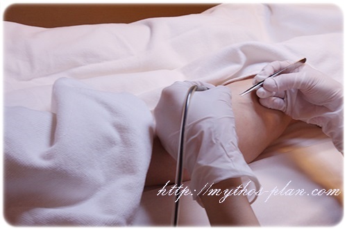 すーぱー脱毛では電気で処理するので、毛はするっと抜ける